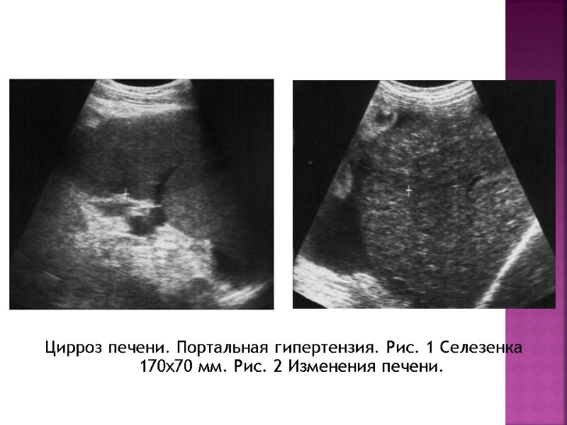 Цирроз печени. Портальная гипертензия. Рис. 1 Селезенка 170х70 мм. Рис. 2 Изменения печени.